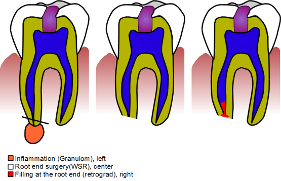 Root end surgery