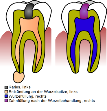 Wurzelbehandlung