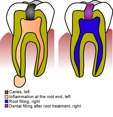 Root treatment