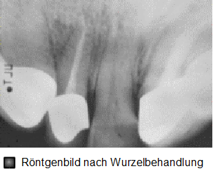 Wurzelbehandlung, Ergebnis