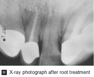 Root treatment, result